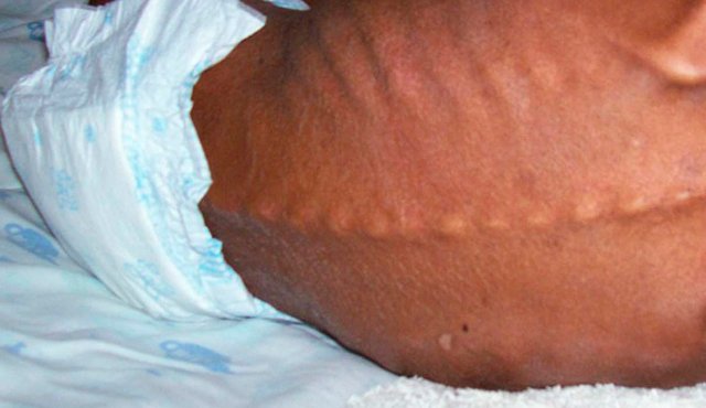 [:es]Por desnutrición muere niño en hospital de Guanare[:]