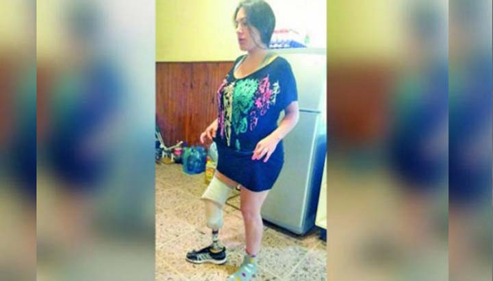 [:es]Fue por una liposucción y salió sin una pierna[:]