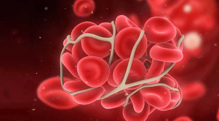 [:es]Conoce mas sobre la Trombofilia[:]