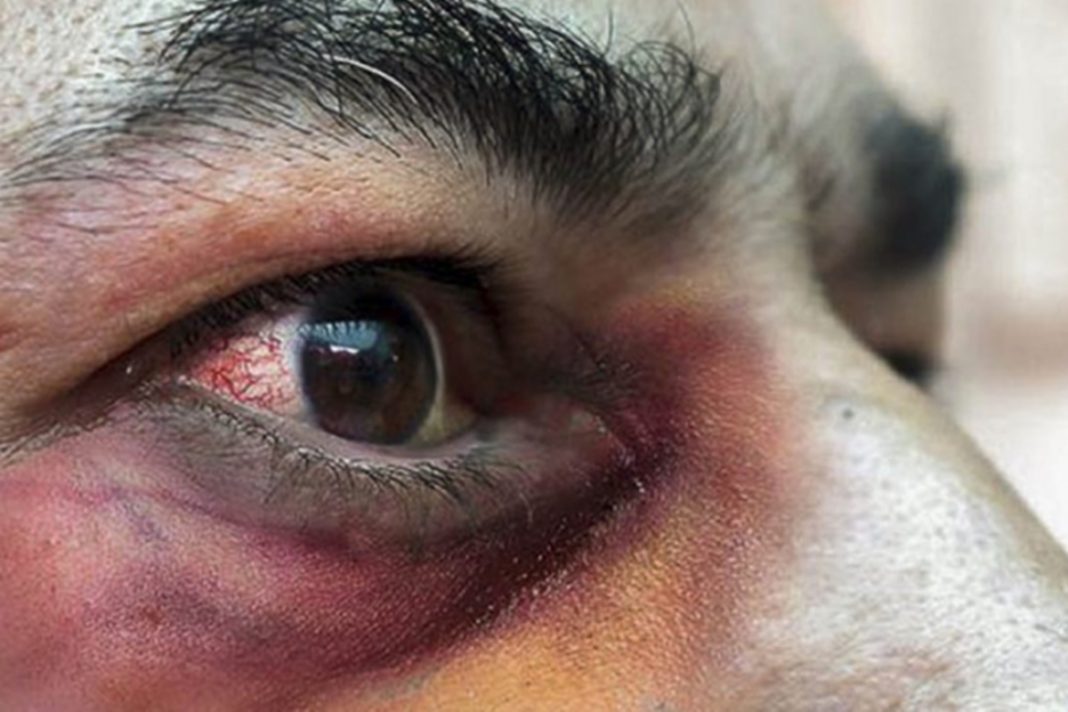 [:es]Detectado primer caso de hongo negro en Venezuela [:]